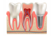 Affordable Dental Implant in Sacramento California