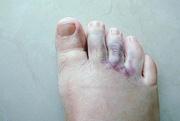 Urgent Care for Stubbed Toe Infection Treatment | Stubbed Toe Care